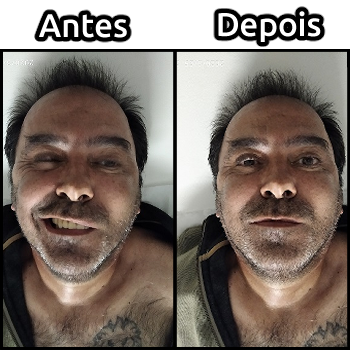 Comparação de músculos faciais antes e depois da massagem para tratamento de paralisia facial.