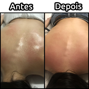 Comparação de coluna antes e depois da massagem para tratamento de escoliose.