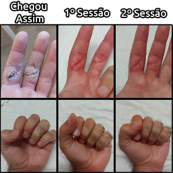 Comparação de mão antes e depois da massagem para recuperação pós-cirurgia.