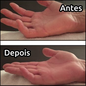 Comparação de mão antes e depois da massagem para recuperação de mobilidade.