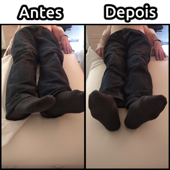 Comparação de anca antes e depois da massagem para correcção postural, recuperação de mobilidade e funcionamento.